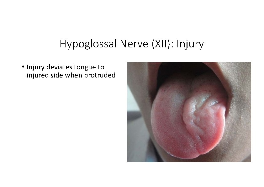 Hypoglossal Nerve (XII): Injury • Injury deviates tongue to injured side when protruded Hypoglossal Nerve (XII): Injury • Injury deviates tongue to injured side when protruded