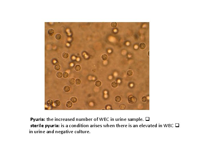 Pyuria: the increased number of WBC in urine sample. q sterile pyuria: is a