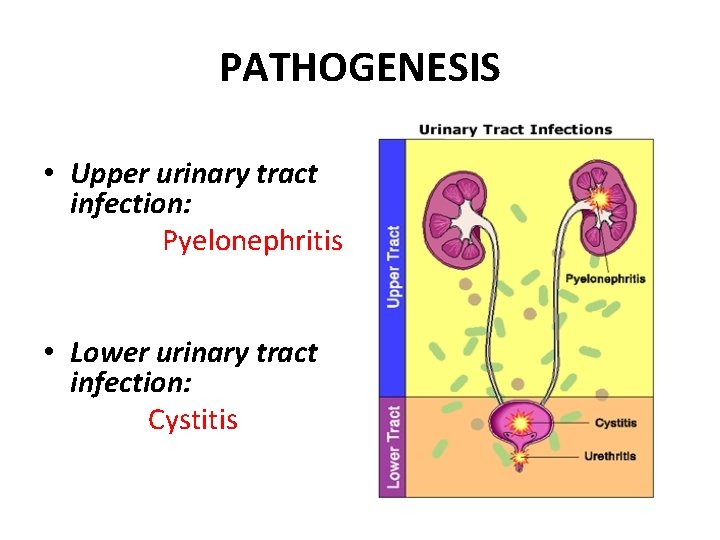 PATHOGENESIS • Upper urinary tract infection: Pyelonephritis • Lower urinary tract infection: Cystitis 