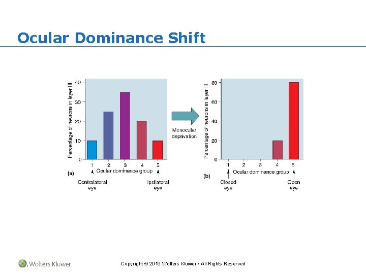 Ocular Dominance Shift Copyright © 2016 Wolters Kluwer • All Rights Reserved 