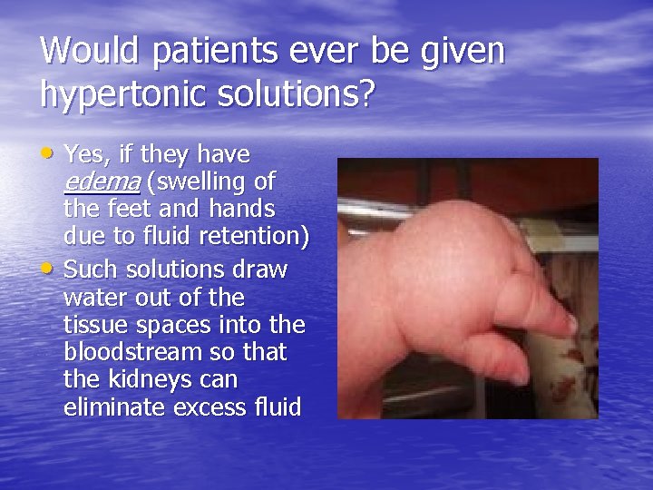 Would patients ever be given hypertonic solutions? • Yes, if they have edema (swelling