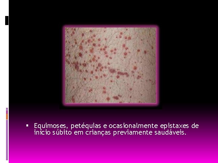  Equimoses, petéquias e ocasionalmente epistaxes de início súbito em crianças previamente saudáveis. 