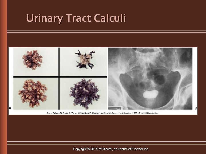 Urinary Tract Calculi Copyright © 2014 by Mosby, an imprint of Elsevier Inc. 