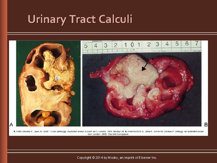 Urinary Tract Calculi Copyright © 2014 by Mosby, an imprint of Elsevier Inc. 