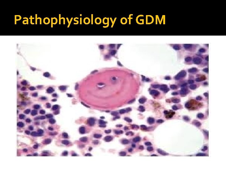 Pathophysiology of GDM 