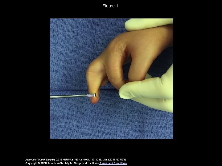 Figure 1 Journal of Hand Surgery 2018 43874. e 1 -874. e 4 DOI: