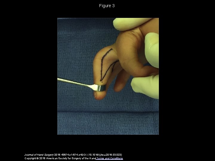 Figure 3 Journal of Hand Surgery 2018 43874. e 1 -874. e 4 DOI: