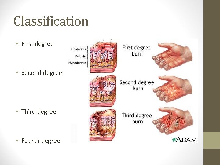 Classification • First degree • Second degree • Third degree • Fourth degree 