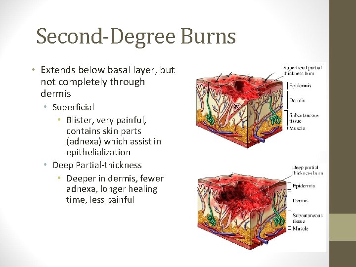 Second-Degree Burns • Extends below basal layer, but not completely through dermis • Superficial