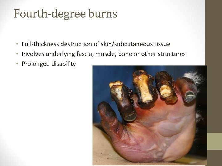 Fourth-degree burns • Full-thickness destruction of skin/subcutaneous tissue • Involves underlying fascia, muscle, bone