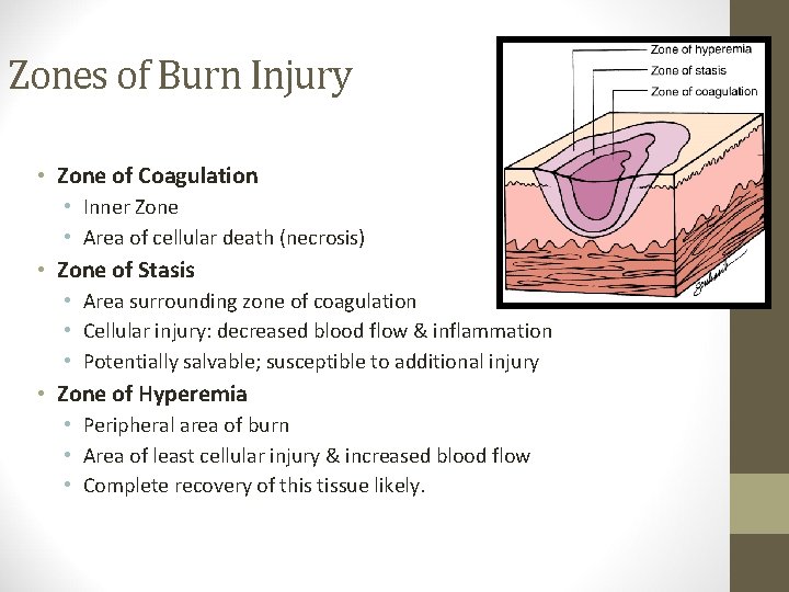 Zones of Burn Injury • Zone of Coagulation • Inner Zone • Area of