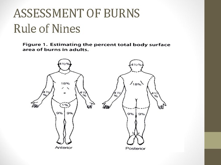 ASSESSMENT OF BURNS Rule of Nines 