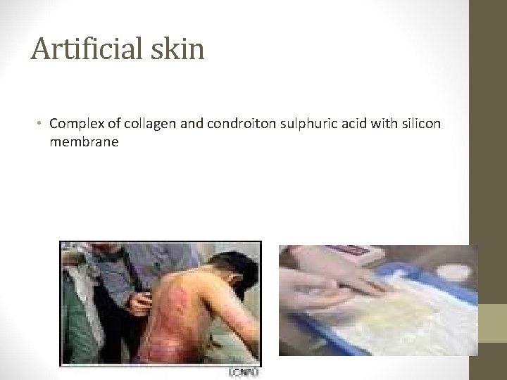 Artificial skin • Complex of collagen and condroiton sulphuric acid with silicon membrane 