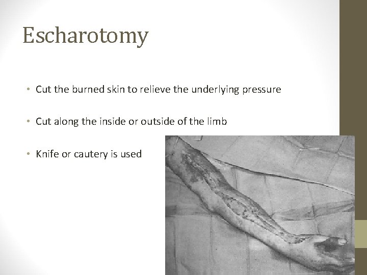 Escharotomy • Cut the burned skin to relieve the underlying pressure • Cut along
