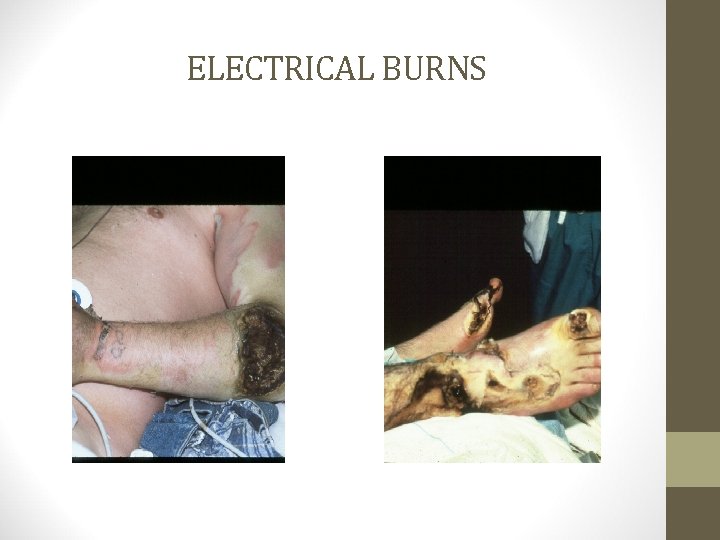 ELECTRICAL BURNS 