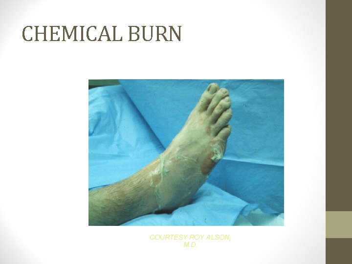 CHEMICAL BURN COURTESY ROY ALSON, M. D. 