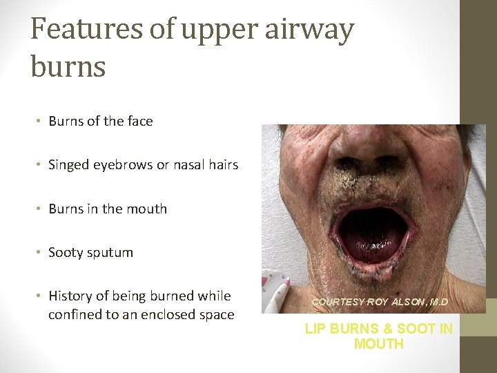Features of upper airway burns • Burns of the face • Singed eyebrows or