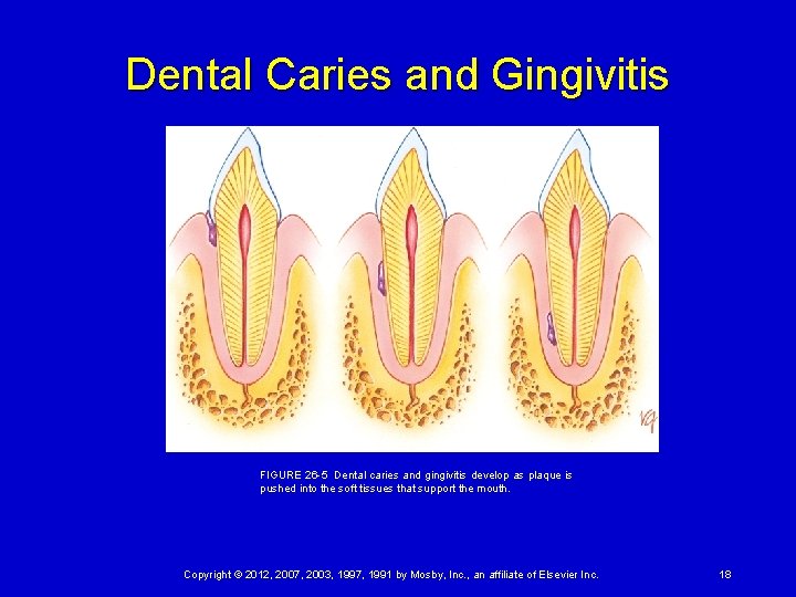 Dental Caries and Gingivitis FIGURE 26 -5 Dental caries and gingivitis develop as plaque is