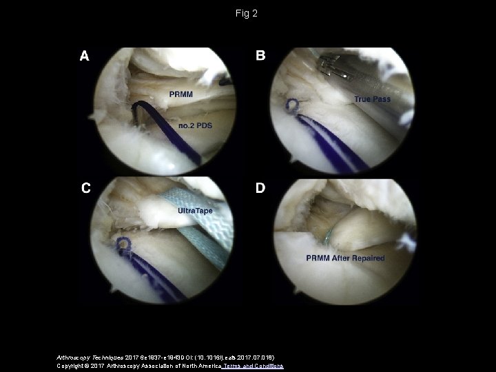 Fig 2 Arthroscopy Techniques 2017 6 e 1937 -e 1943 DOI: (10. 1016/j. eats.