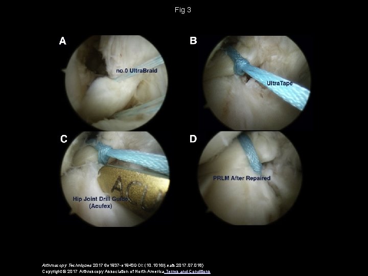 Fig 3 Arthroscopy Techniques 2017 6 e 1937 -e 1943 DOI: (10. 1016/j. eats.