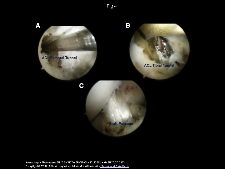 Fig 4 Arthroscopy Techniques 2017 6 e 1937 -e 1943 DOI: (10. 1016/j. eats.