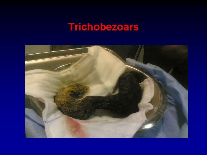 Trichobezoars 