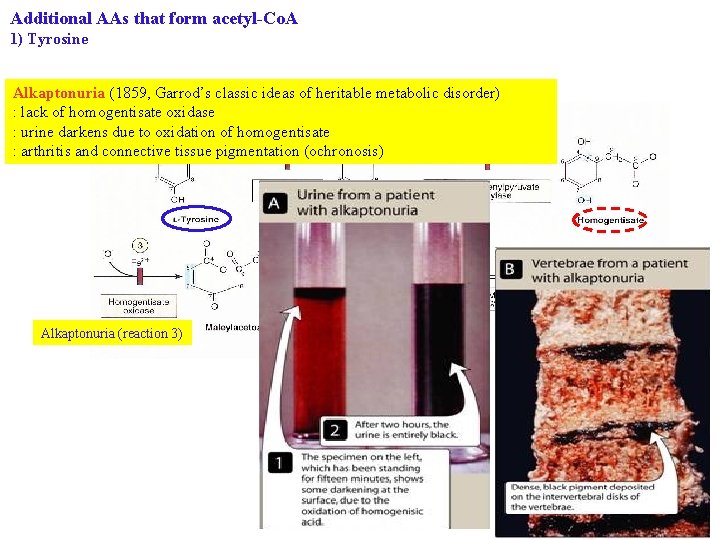 Additional AAs that form acetyl-Co. A 1) Tyrosine Alkaptonuria (1859, Garrod’s classic ideas of