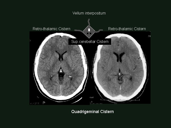 Vellum interpositum Retro-thalamic Cistern Sup. cerebellar Cistern Quadrigeminal Cistern 