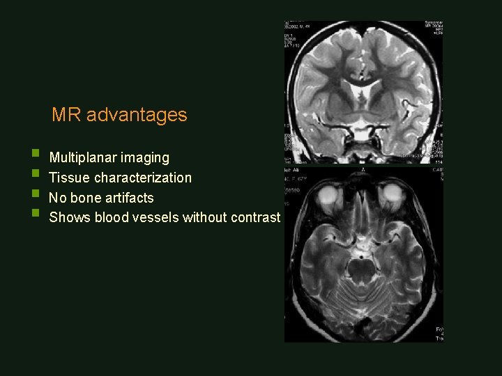 MR advantages § Multiplanar imaging § Tissue characterization § No bone artifacts § Shows