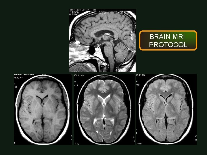 BRAIN MRI PROTOCOL 