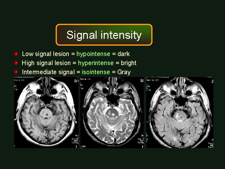 Signal intensity Low signal lesion = hypointense = dark High signal lesion = hyperintense