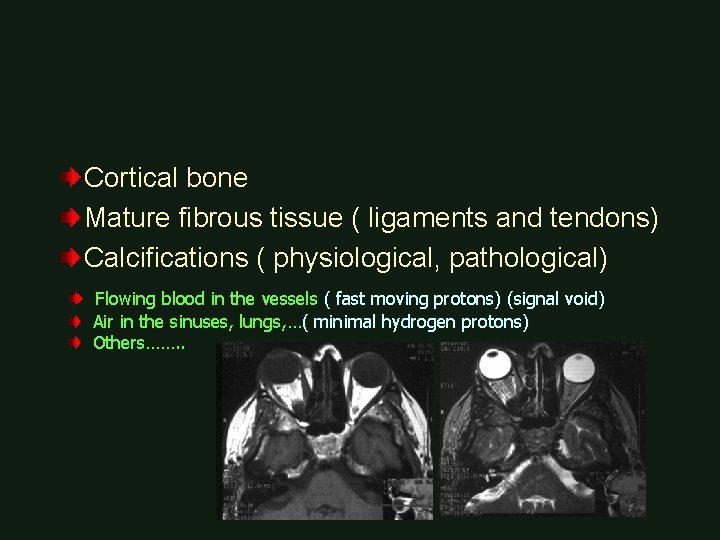 Cortical bone Mature fibrous tissue ( ligaments and tendons) Calcifications ( physiological, pathological) Flowing