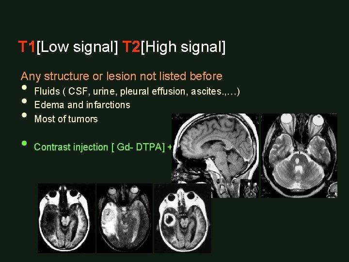 T 1[Low signal] T 2[High signal] Any structure or lesion not listed before •