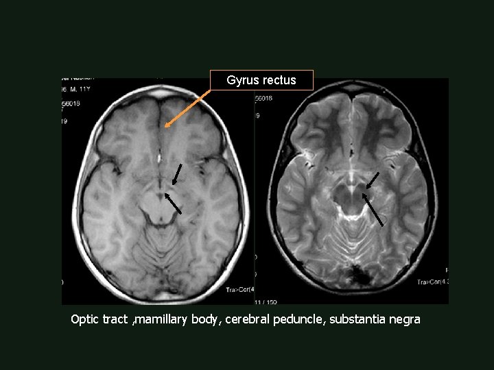 Gyrus rectus Optic tract , mamillary body, cerebral peduncle, substantia negra 