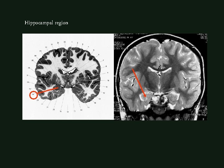 Hippocampal region 