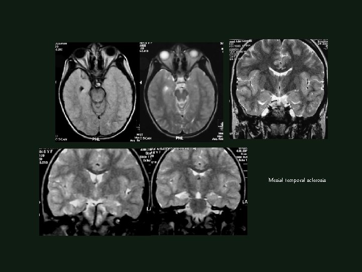 Mesial temporal sclerosis 