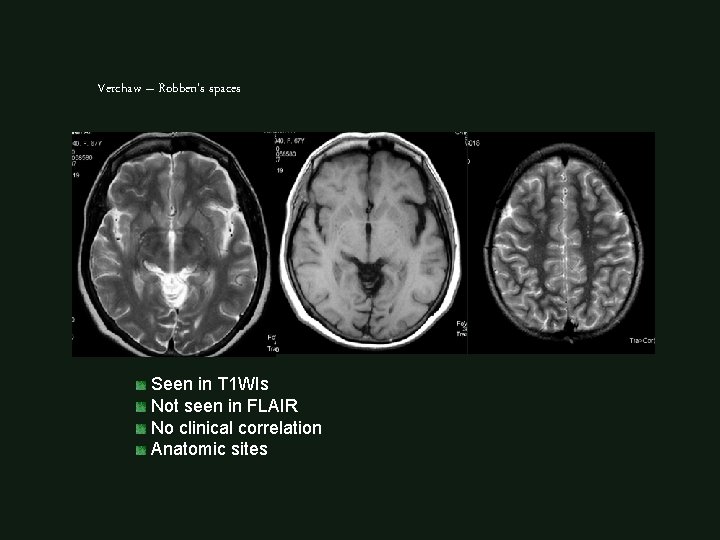 Verchaw – Robben’s spaces Seen in T 1 WIs Not seen in FLAIR No