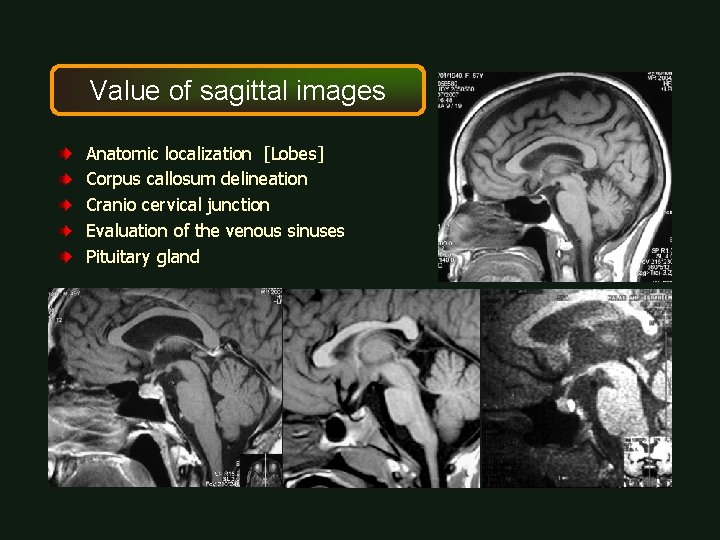 Value of sagittal images Anatomic localization [Lobes] Corpus callosum delineation Cranio cervical junction Evaluation