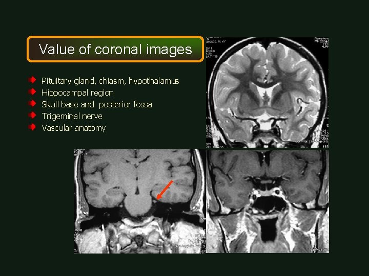 Value of coronal images Pituitary gland, chiasm, hypothalamus Hippocampal region Skull base and posterior