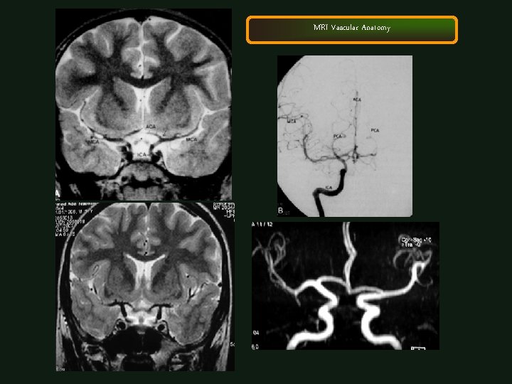 MRI Vascular Anatomy 