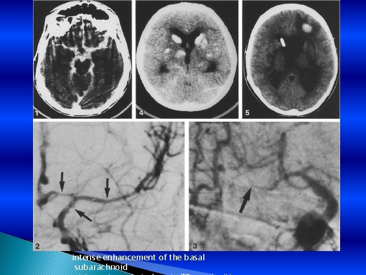 intense enhancement of the basal subarachnoid 