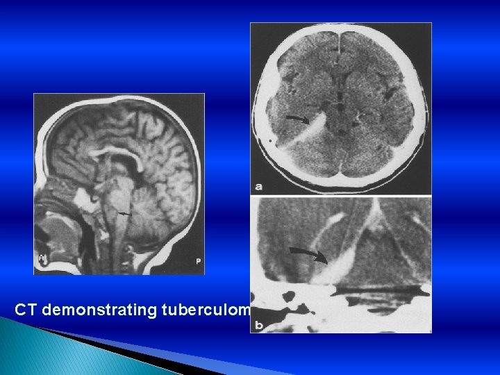 CT demonstrating tuberculoma 