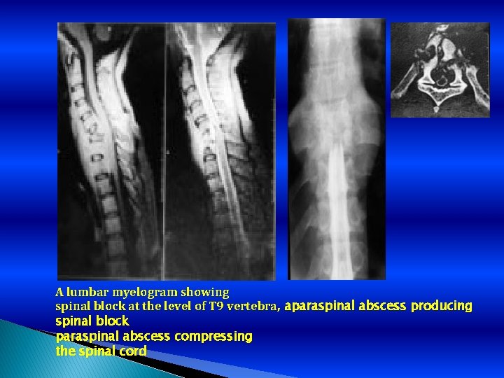 A lumbar myelogram showing spinal block at the level of T 9 vertebra, aparaspinal