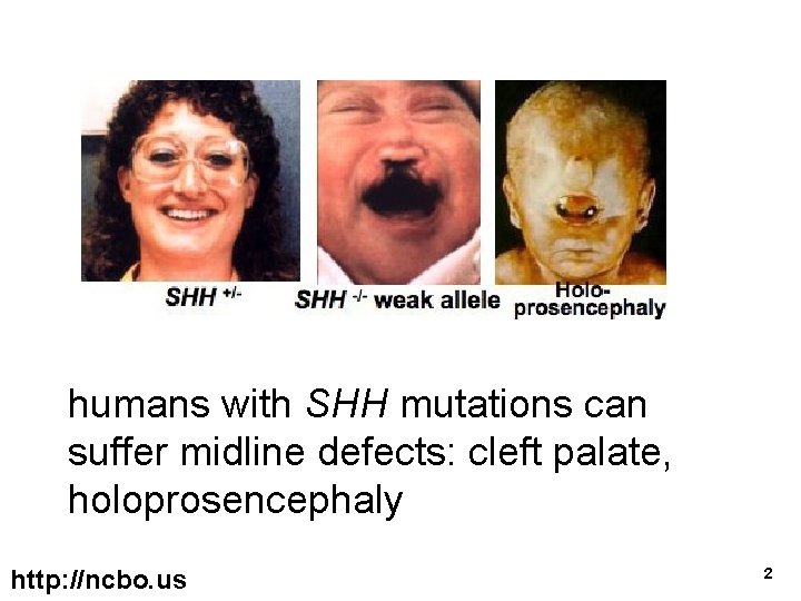 humans with SHH mutations can suffer midline defects: cleft palate, holoprosencephaly http: //ncbo. us