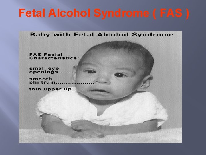 Fetal Alcohol Syndrome ( FAS ) 