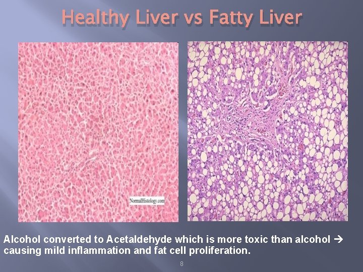 Healthy Liver vs Fatty Liver Alcohol converted to Acetaldehyde which is more toxic than