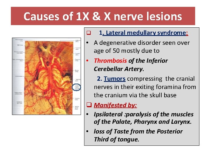 Causes of 1 X & X nerve lesions 1. Lateral medullary syndrome: • A