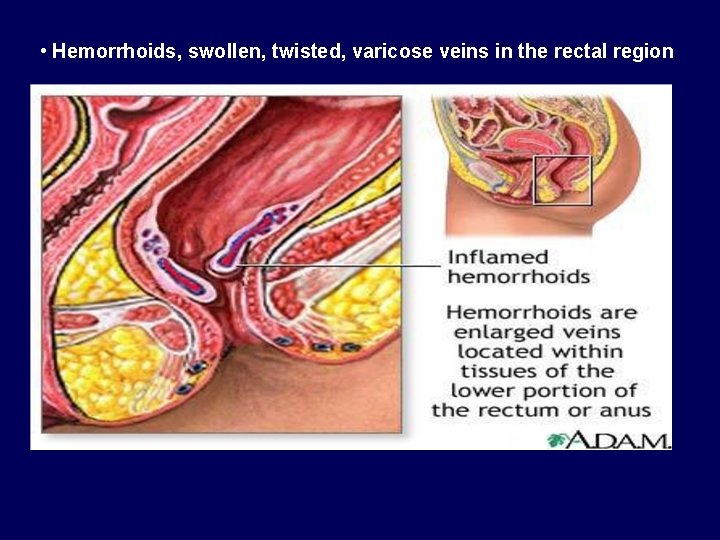  • Hemorrhoids, swollen, twisted, varicose veins in the rectal region 