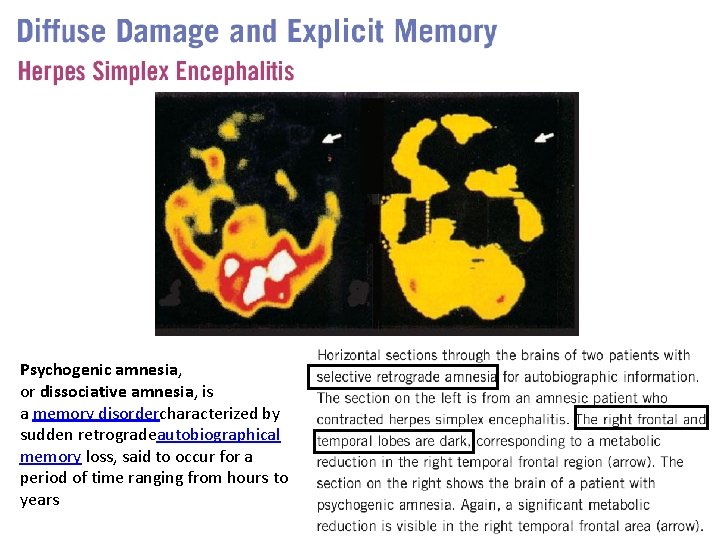 Psychogenic amnesia, or dissociative amnesia, is a memory disordercharacterized by sudden retrogradeautobiographical memory loss,