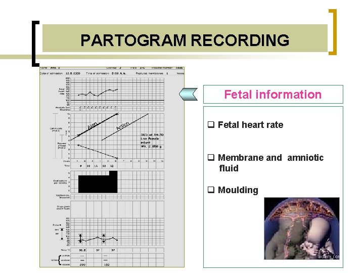 PARTOGRAM RECORDING Fetal information q Fetal heart rate q Membrane and amniotic fluid q